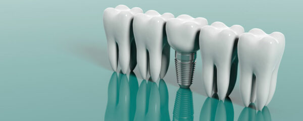 Les implants dentaires