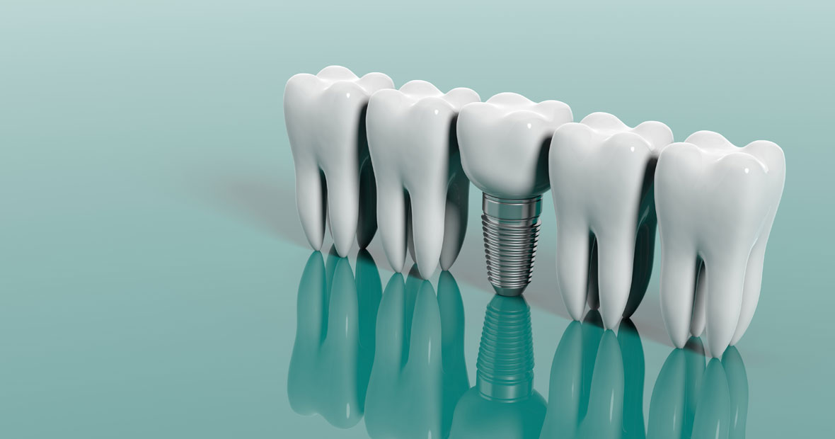 Les implants dentaires